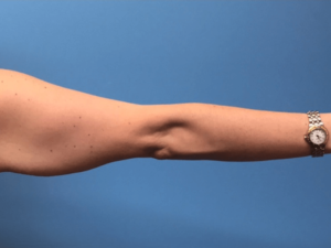 Brachioplasty-Case--276 | Before Arm Lift 2