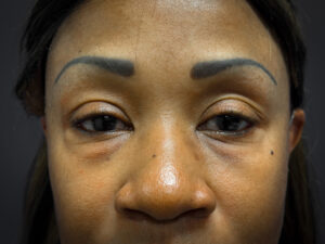 Facelift-Lower-Blepharoplasty-Case--6866 | Before Facelift 2