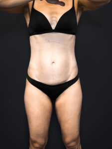 Tummy-Tuck-Case--2729 | Before Tummy Tuck 1