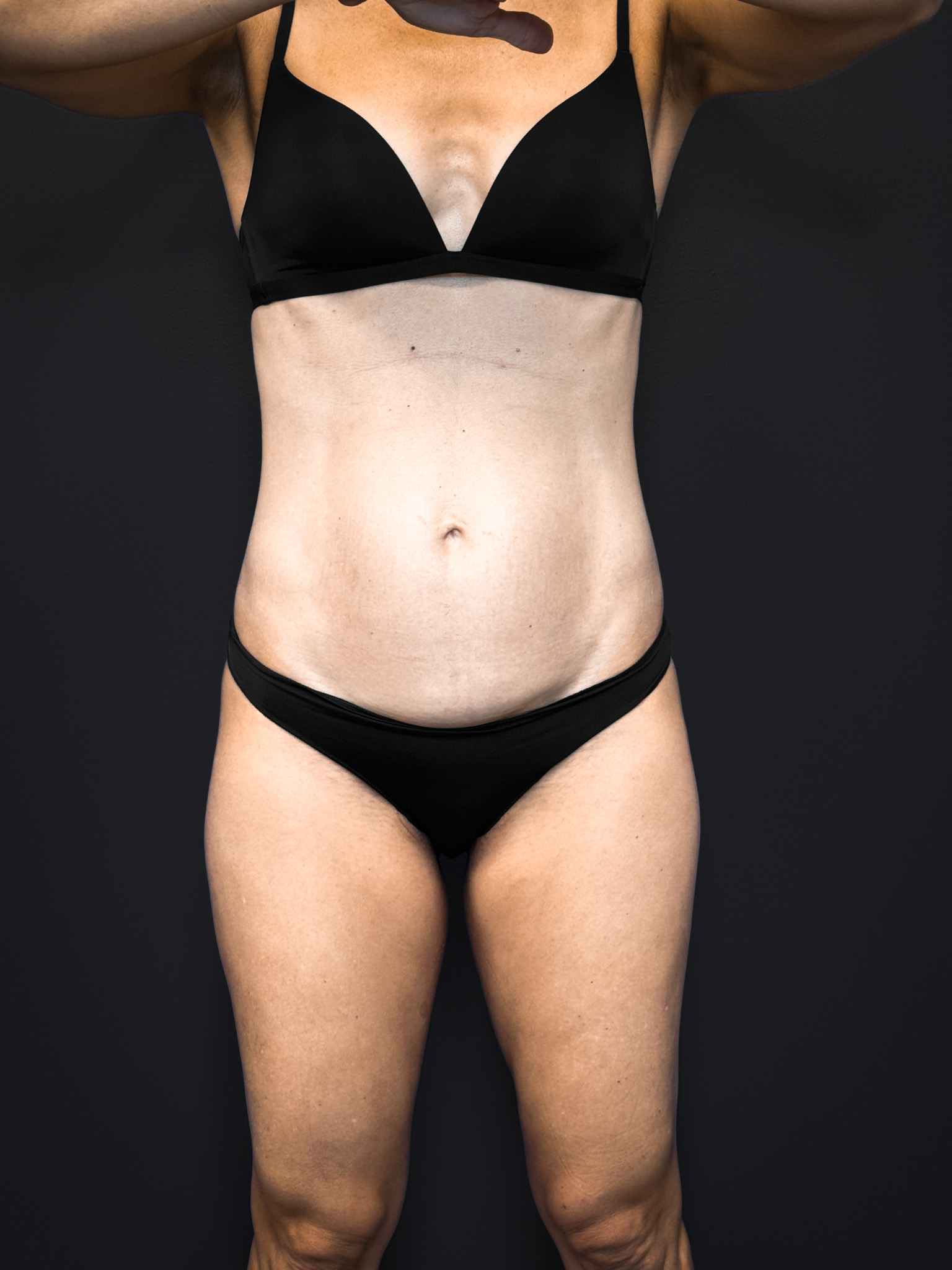 Tummy-Tuck-Case--2729 | Before Tummy Tuck 1