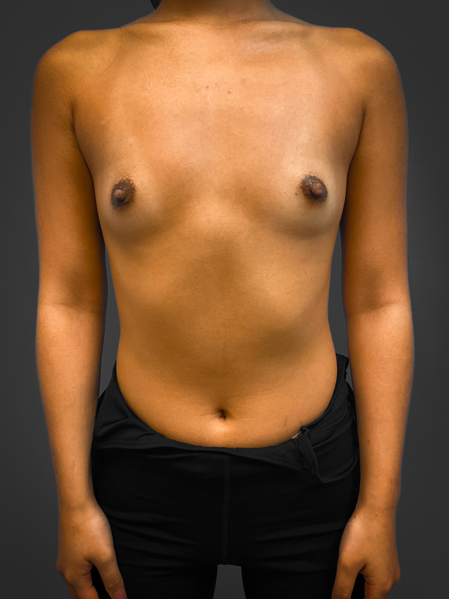 Breast-Augmentation-Case--4631 | Before Breast Augmentation 1