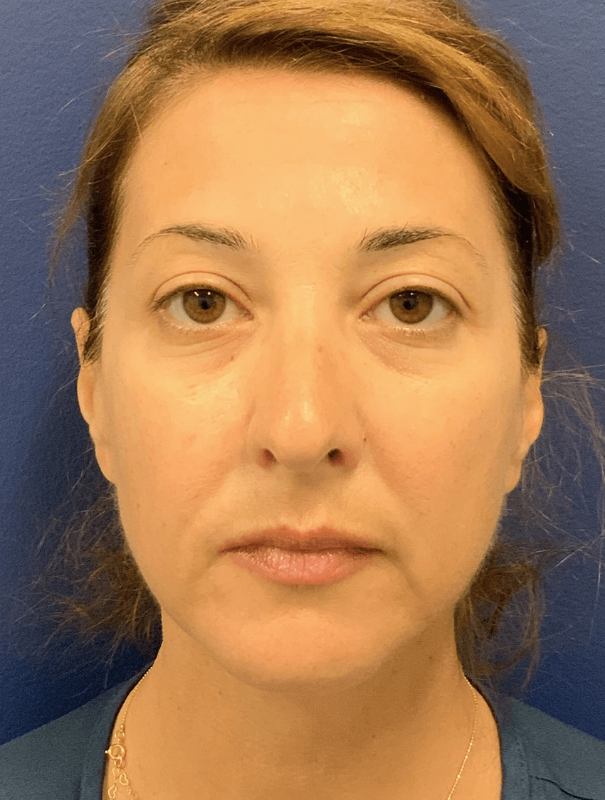 Case--20575 | Before Facelift 1