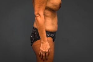 Abdominoplasty-Flank-Liposuction-Case--6263 | Before Liposuction 2