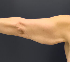 Brachioplasty-Case--6382 | Before Arm Lift 2