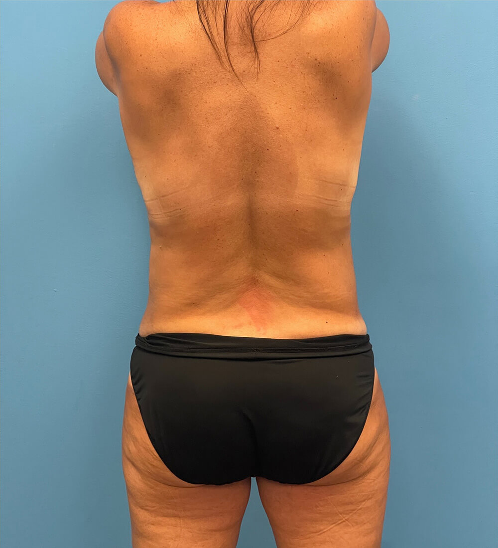 Case--26141 | Before Mommy Makeover 2