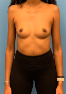 Breast-Augmentation-Case--26022 | Before Dr. Frank Albino 1