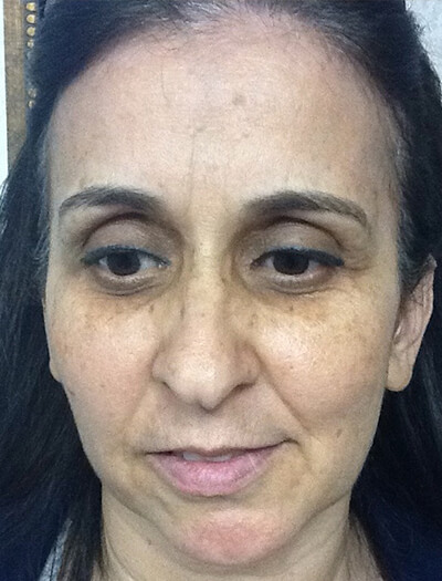 Case--36 | Before Skin Care 1