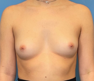Breast-Augmentation-Case--224 | Before Breast Augmentation 1