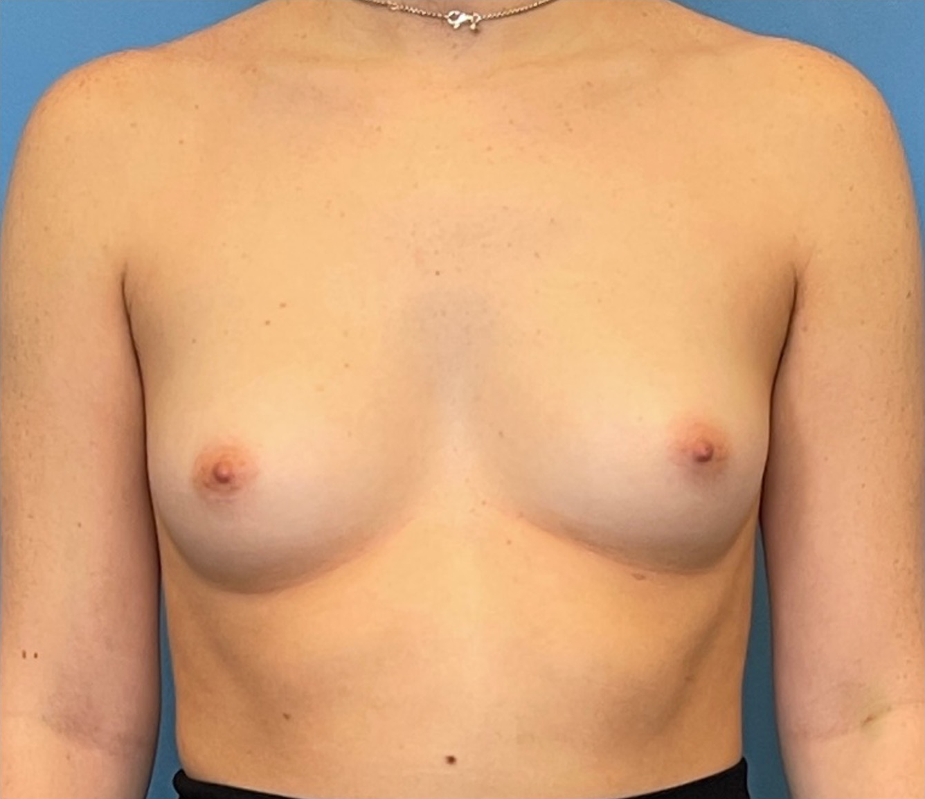 Breast-Augmentation-Case--224 | Before Breast Augmentation 1