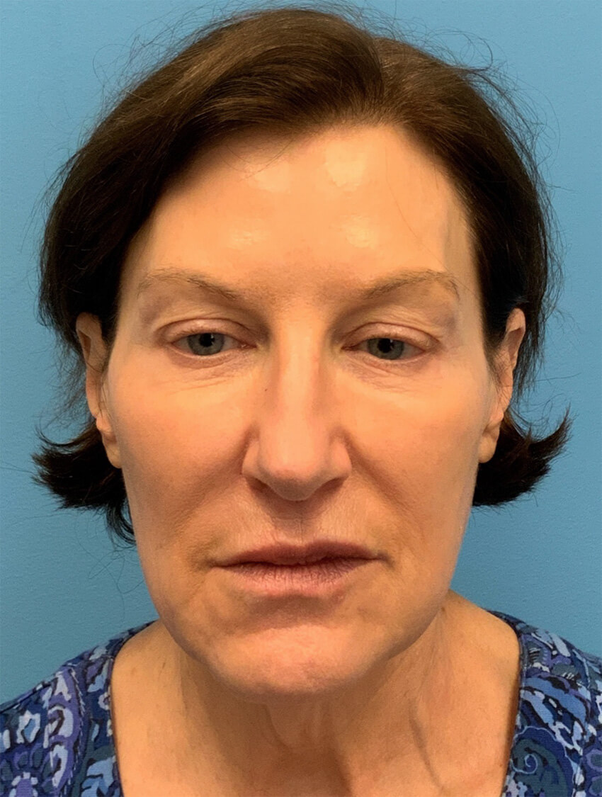 Case--9966 | Before Facelift 1