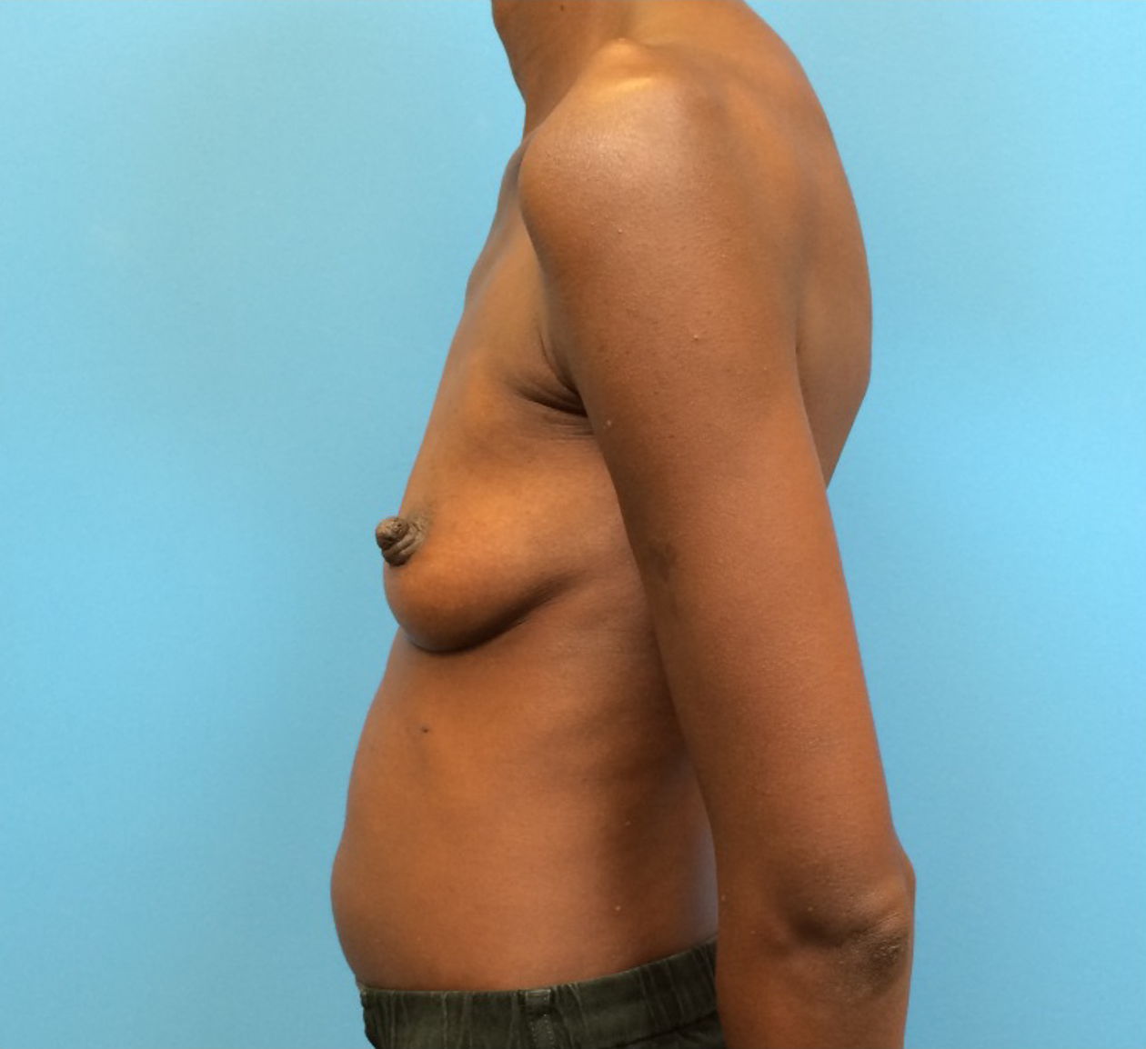 Case--97 | Before Breast Augmentation 2