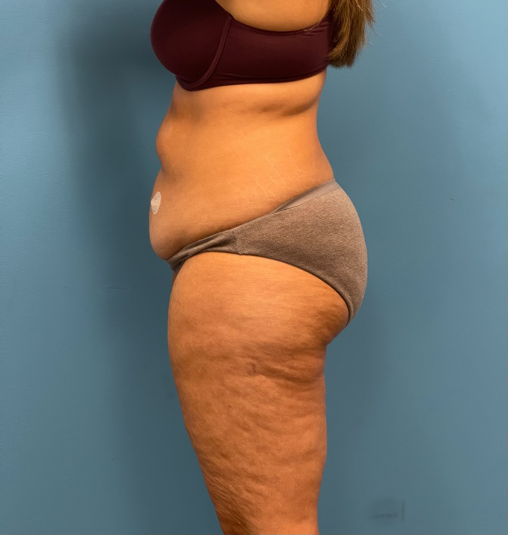 Tummy-Tuck-Case--25555 | Before Tummy Tuck 2