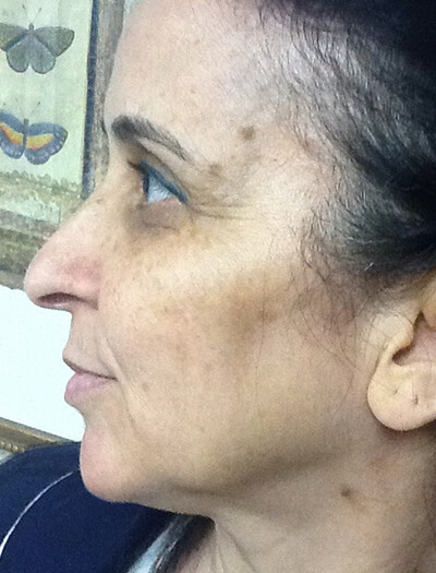 Case--36 | Before Skin Care 2