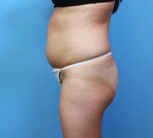 Brazilian-Butt-Lift-Case--265 | Before Brazilian Butt Lift 1