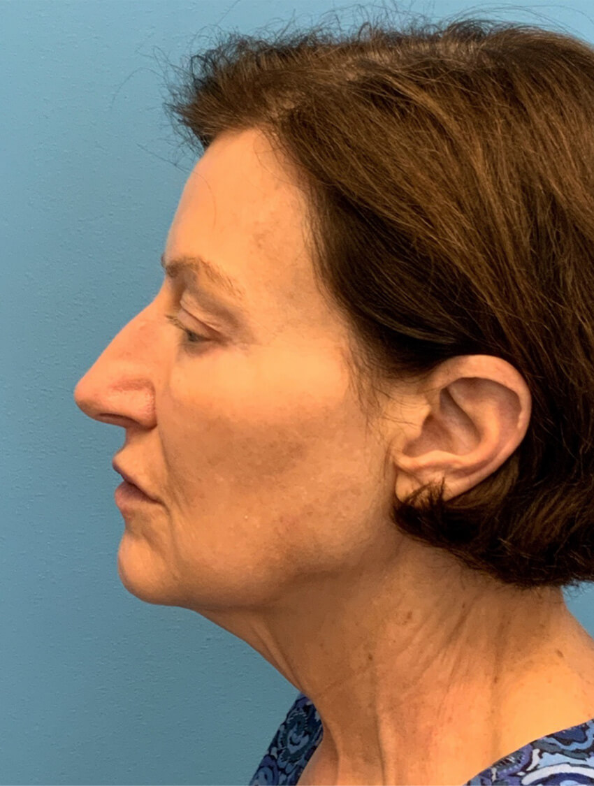 Case--9966 | Before Facelift 2