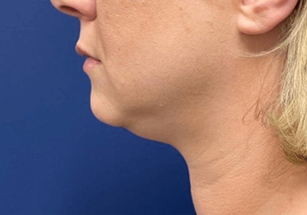 Case--20811 | Before Liposuction 1