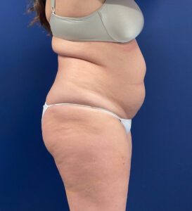 Lipoabdominoplasty-Case--24903 | Before Tummy Tuck 2