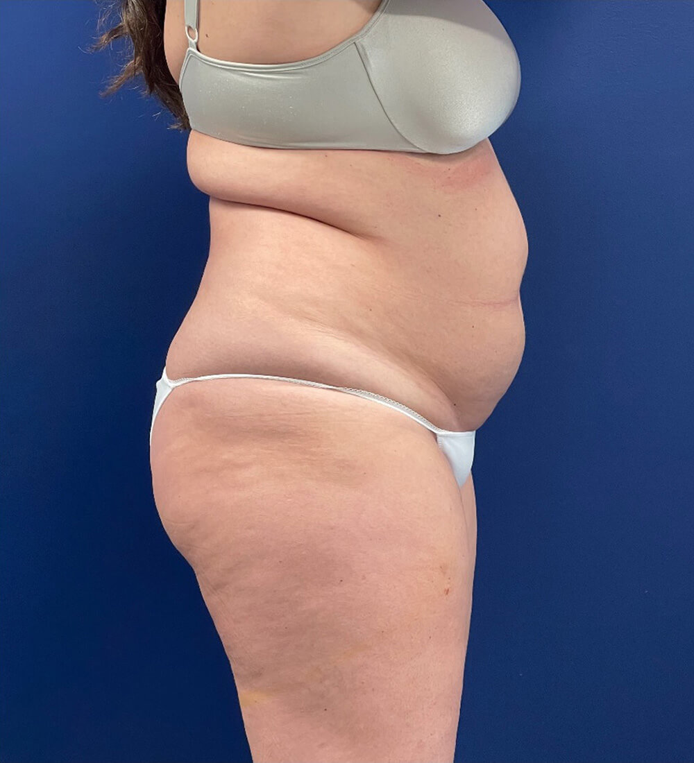 Case--24903 | Before Tummy Tuck 2