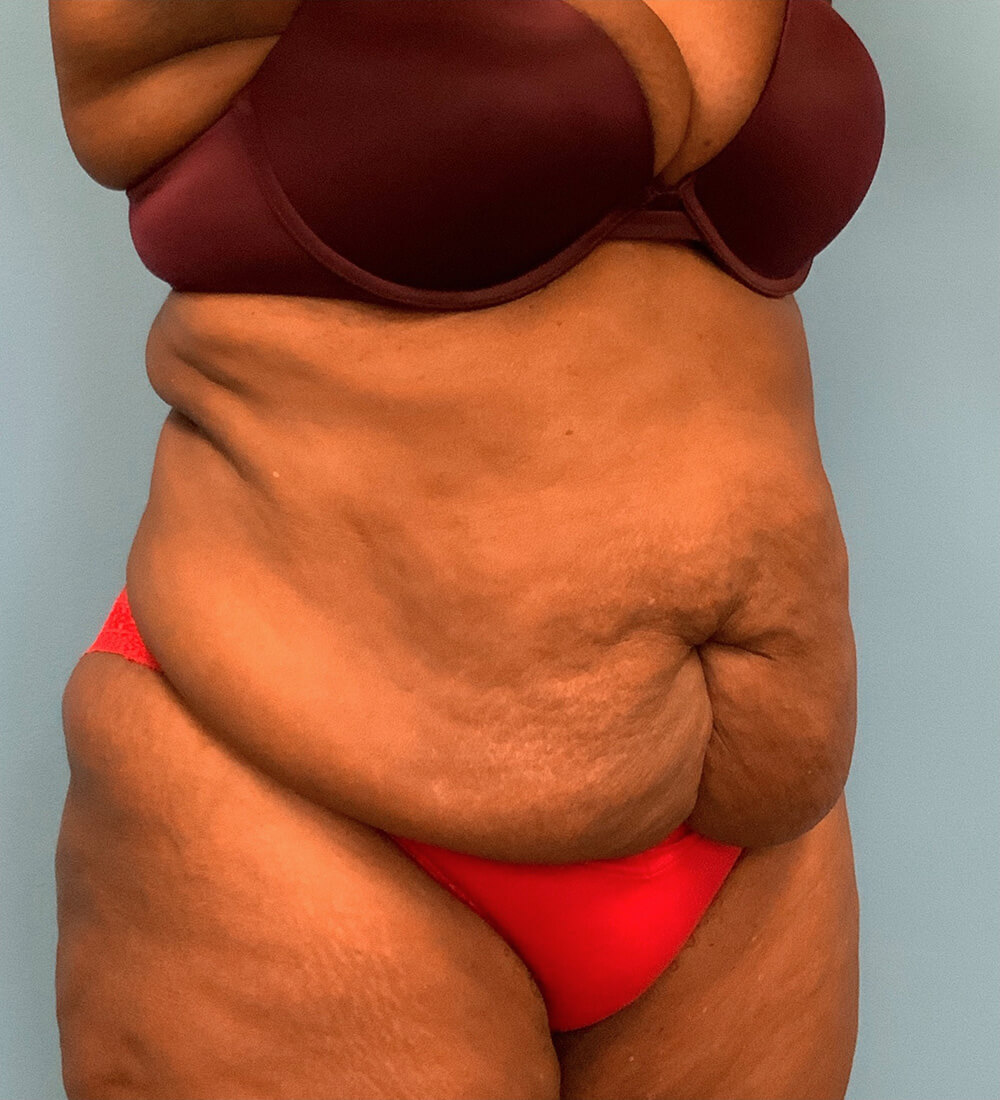 Case--24124 | Before Tummy Tuck 2