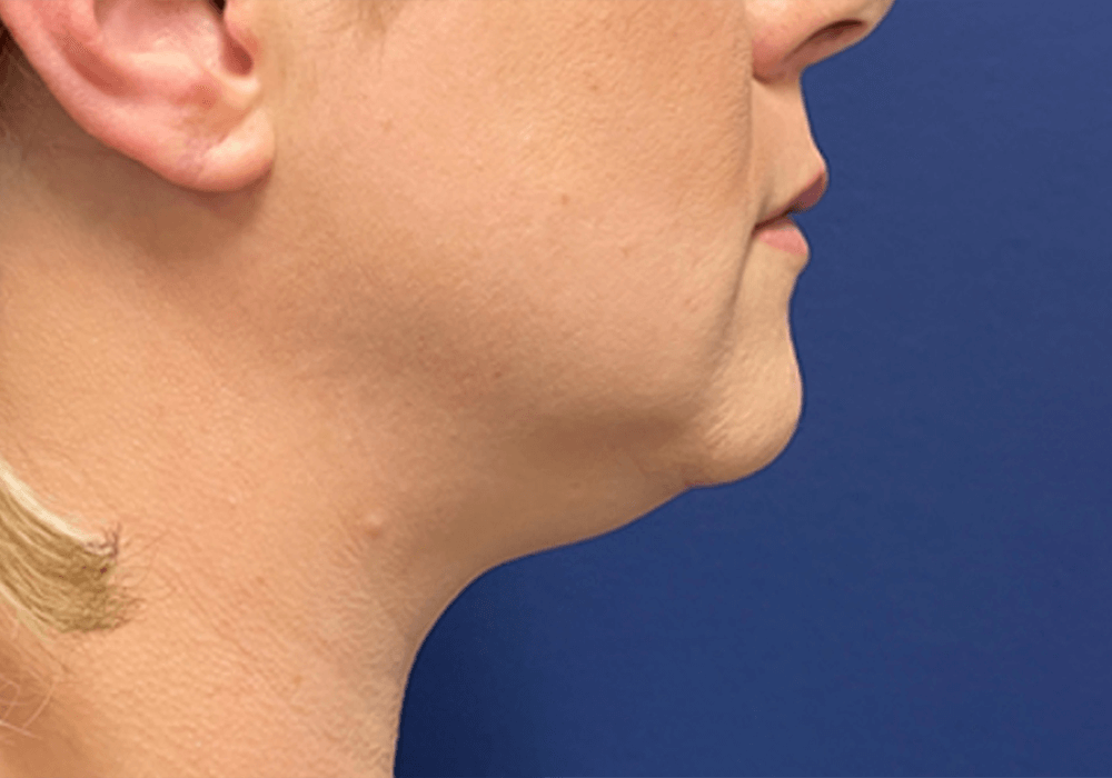 Case--20811 | Before Liposuction 2