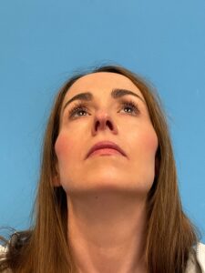 Rhinoplasty-Case--1281 | Before Rhinoplasty 2