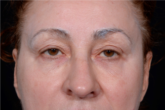 Blepharoplasty-Case--9685 | Before Eyelid Surgery 1