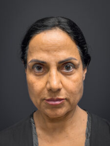 Facial-Fat-Grafting-Case--8416 | Before Facial Fat Grafting 1