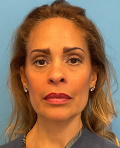 Facial-Fat-Grafting-Case--4152 | Before Facial Fat Grafting 1