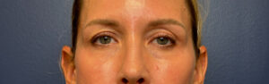 Blepharoplasty-Case--8003 | Before Eyelid Surgery 1