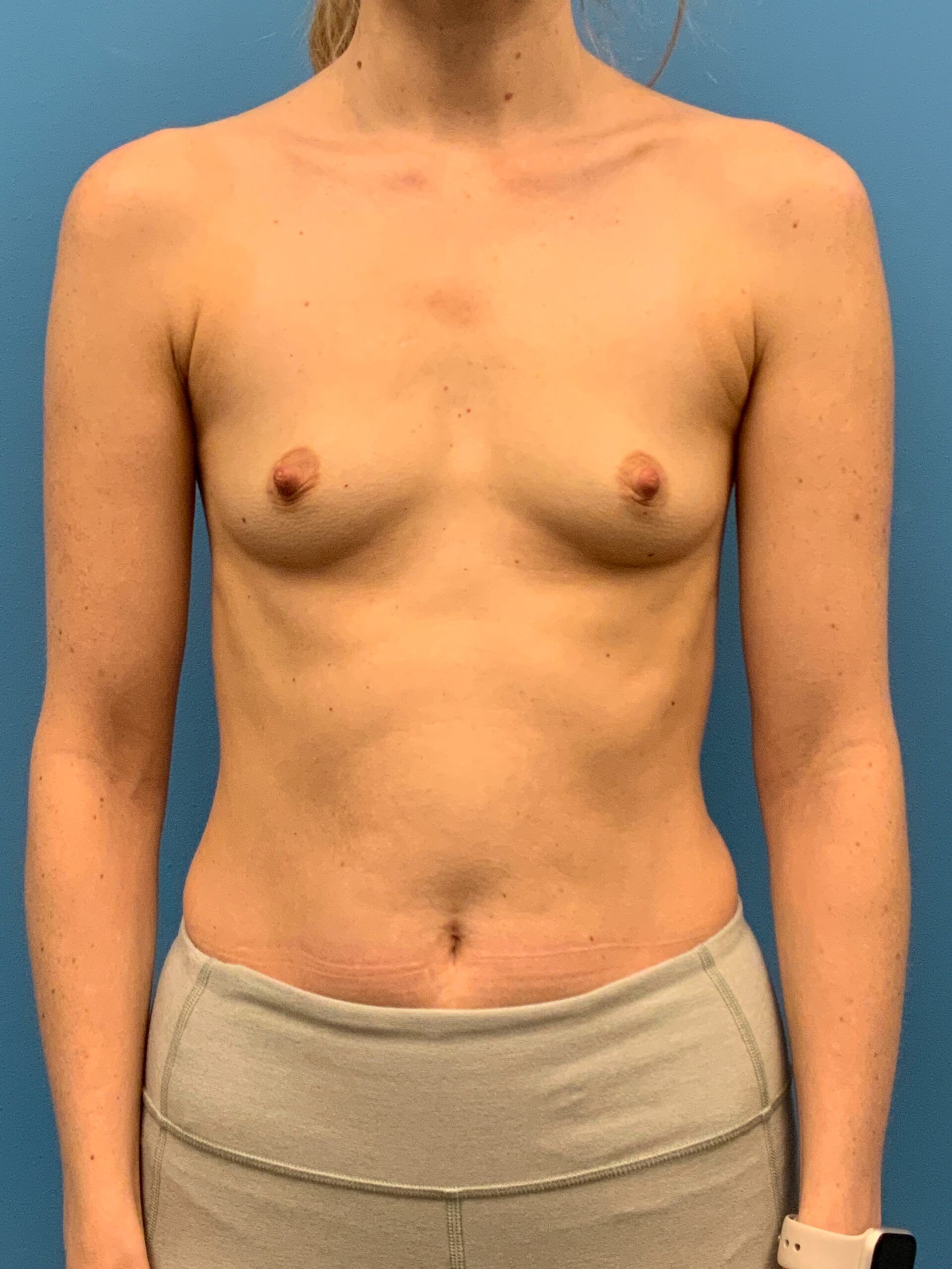 Breast-Augmentation-Case--3526 | Before Breast Augmentation 1