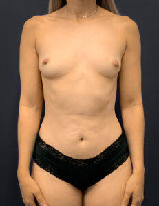Breast-Augmentation-Case--5691 | Before Dr. Arjun Kanuri 1