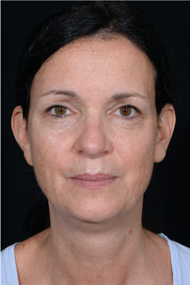 Face-and-Neck-Lift-Case--9403 | Before Facelift 1