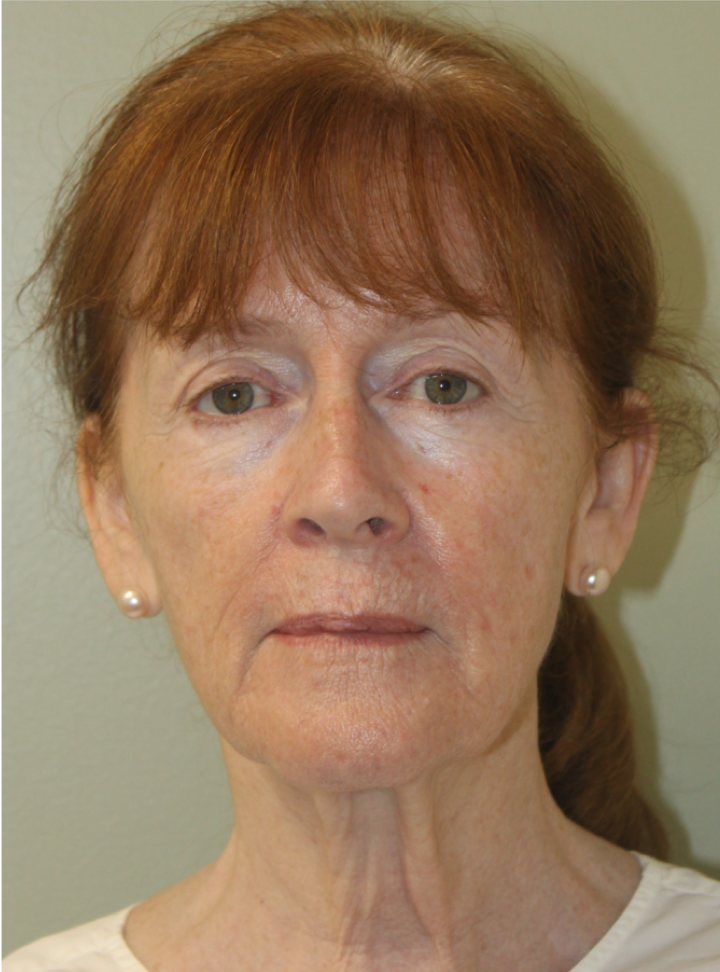 Face-and-Neck-Lift-Case--9302 | Before Facelift 1