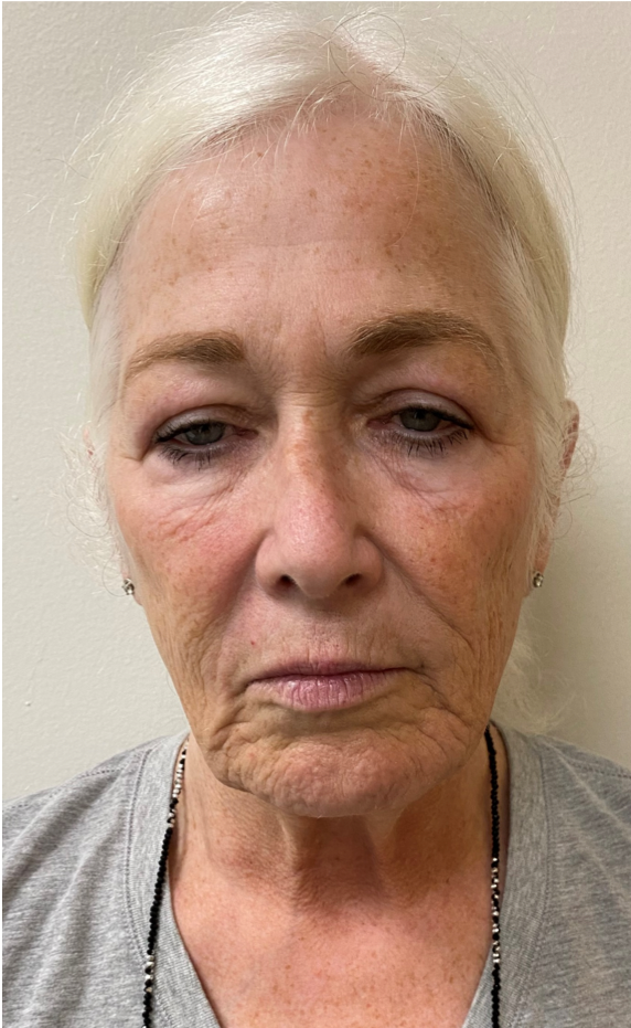 Face-and-Neck-Case--1975 | Before Facelift 1