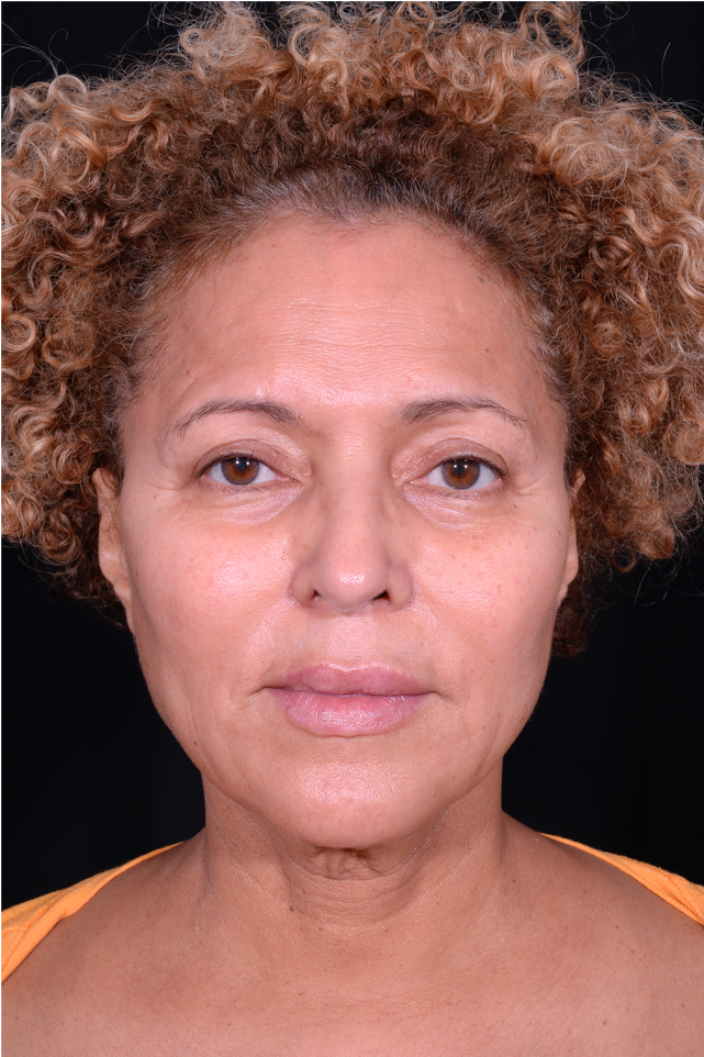 Face-and-Neck-Lift-Case--3772 | Before Facelift 1