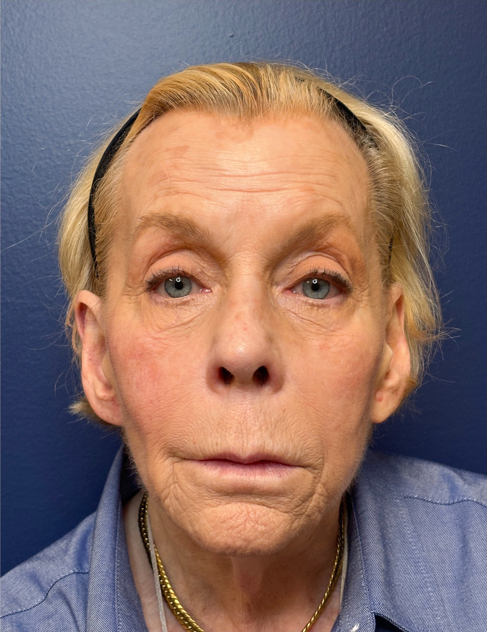 Facelift-Case--9999 | Before Facelift 1