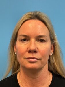 Facial-Fat-Grafting-Case--1028 | Before Facial Fat Grafting 1