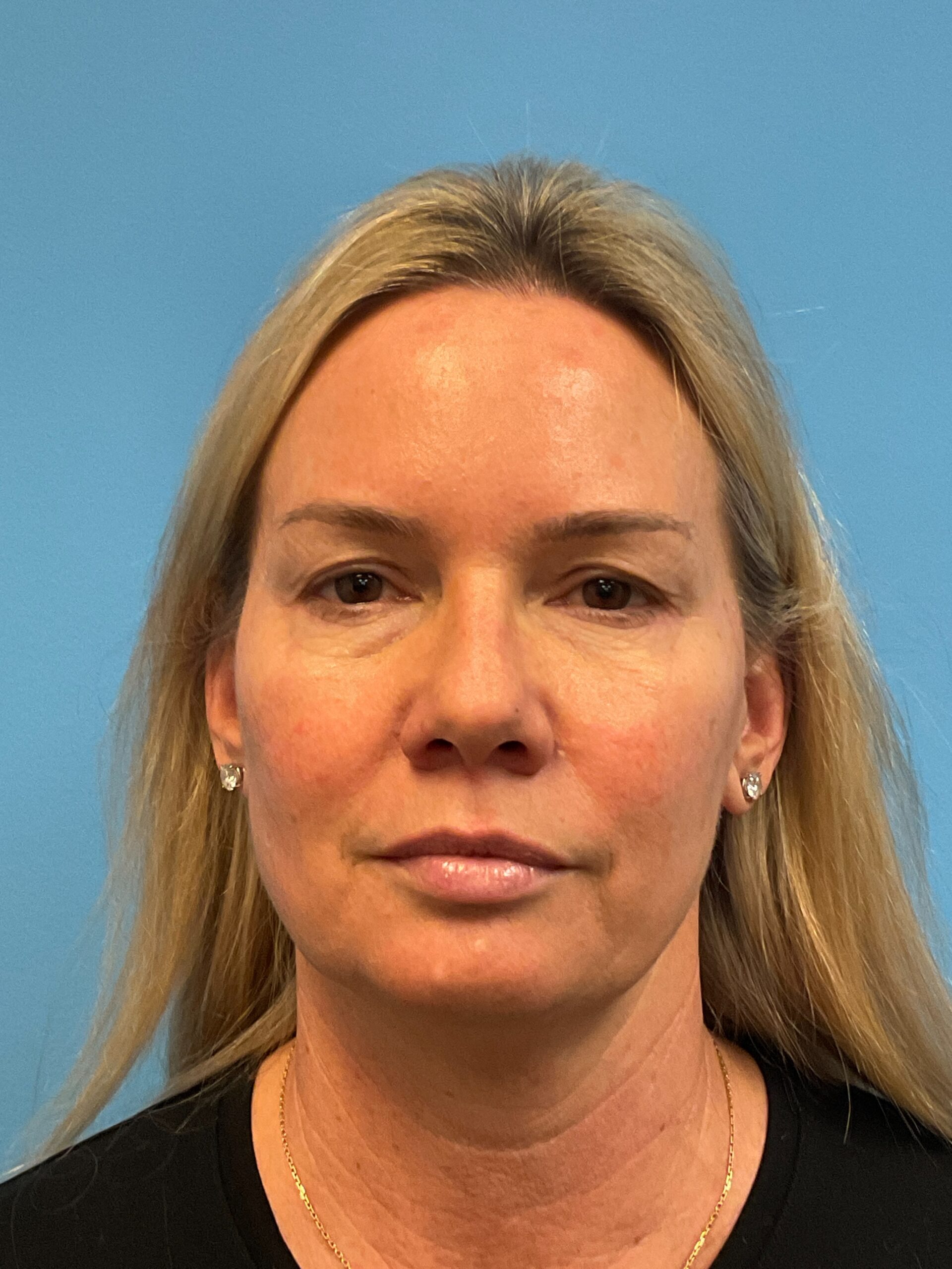 Facelift-Case--9781 | Before Facelift 1