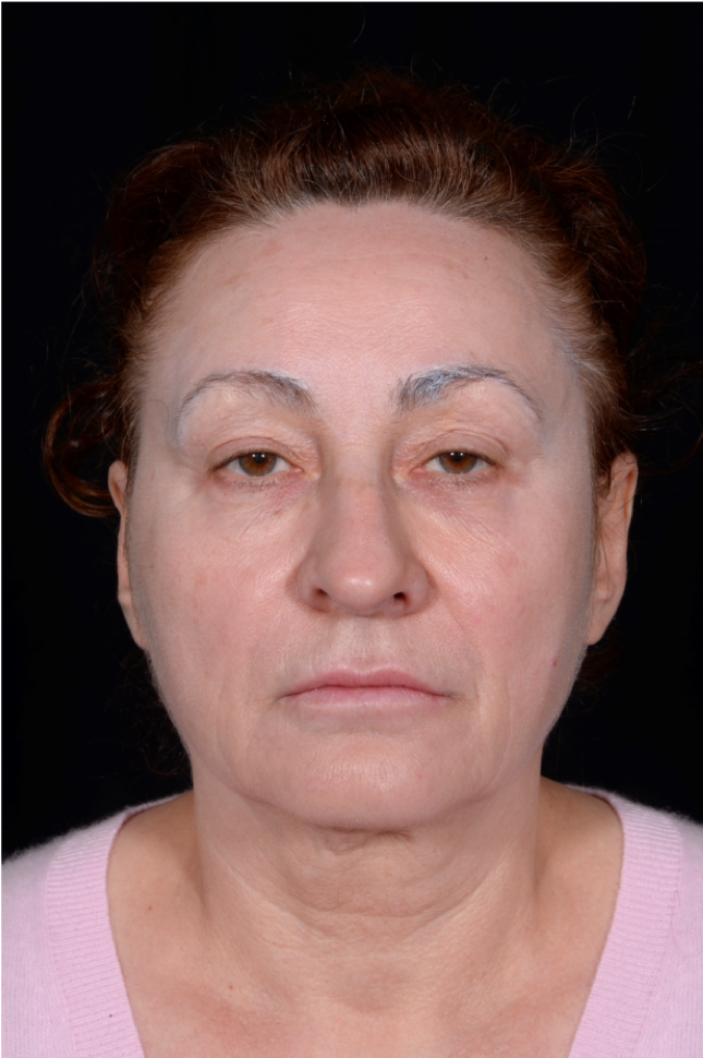 Face-and-Neck-Lift-Case--8423 | Before Facelift 1
