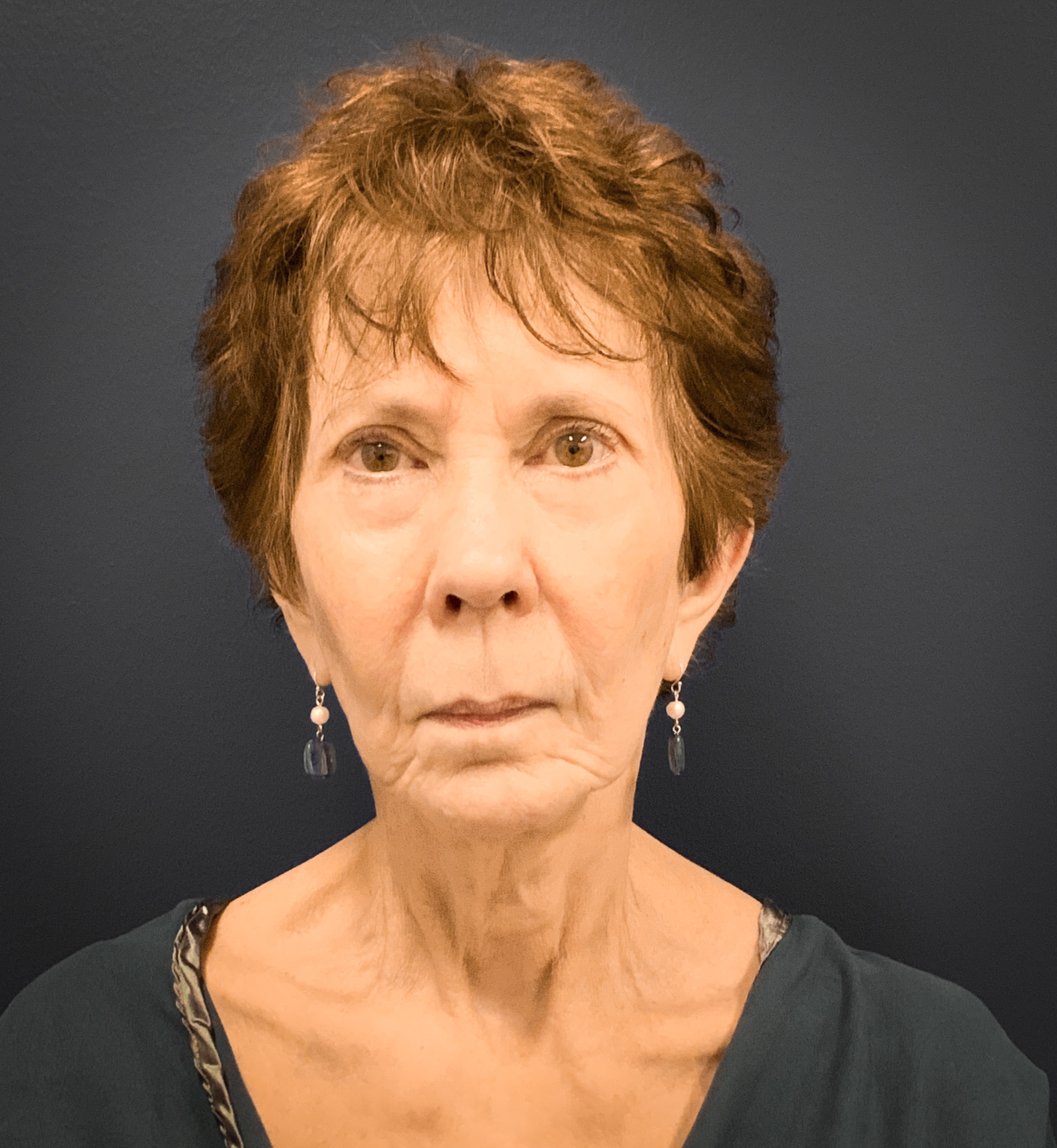 Facelift-Case--8727 | Before Facelift 1