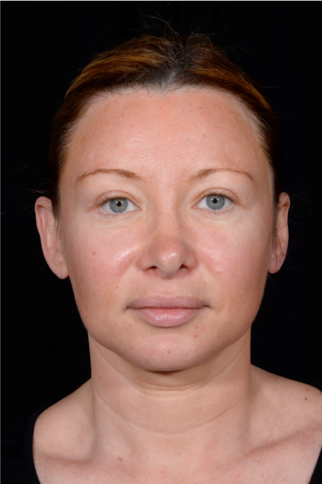 Revision-Facelift-Case--5350 | Before Facelift 1