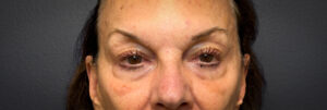 Upper-Blepharoplasty-Case--2075 | Before Dr. Arjun Kanuri 1