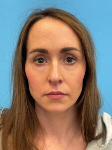 Rhinoplasty-Case--1281 | Before Rhinoplasty 1