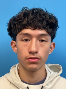 Rhinoplasty-Case--2339 | Before Rhinoplasty 1