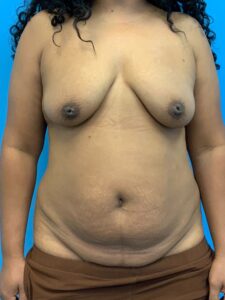 Abdominoplasty-Case--1110 | Before Tummy Tuck 1