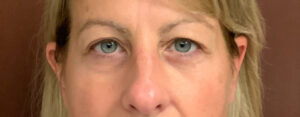 Upper-Blepharoplasty-Case--7202 | Before Dr. Arjun Kanuri 1