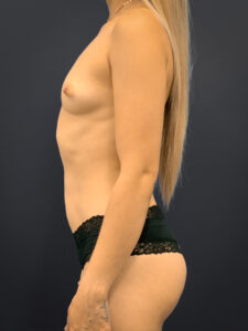 Breast-Augmentation-Case--5691 | Before Dr. Arjun Kanuri 2