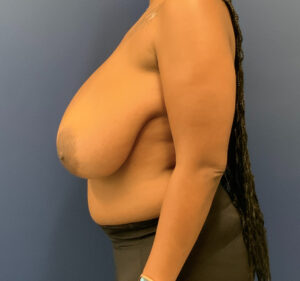 Breast-Reduction-Case--9235 | Before Breast Reduction 2