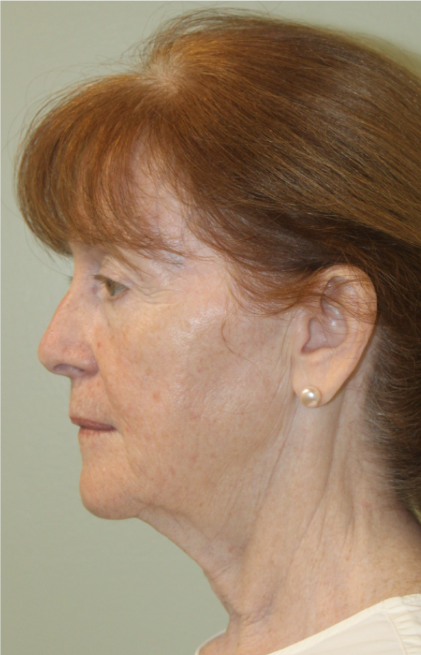 Face-and-Neck-Lift-Case--9302 | Before Facelift 2