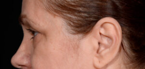 Quad-Blepharoplasty-Case--1851 | Before Dr. Arjun Kanuri 2